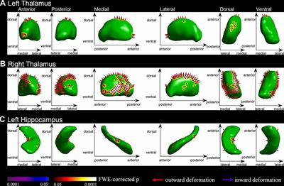 Brain Cortical Complexity and Subcortical Morphometrics in Lifelong Premature Ejaculation